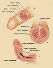 Induratio penis plastica